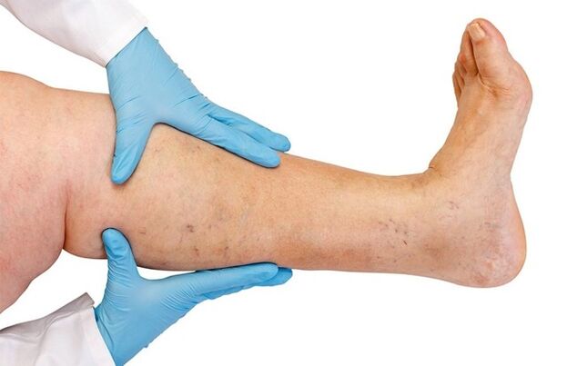 varicose veins in the legs